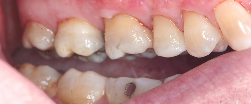 connective tissue graft after