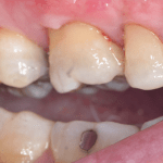 connective tissue graft after