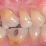 connective tissue graft before