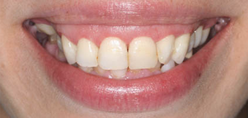 Esthetic Crown Lengtheneing After