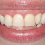 Esthetic Crown Lengtheneing After