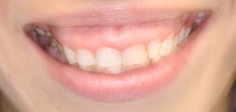 Esthetic Crown Lengthening Before