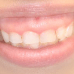 Esthetic Crown Lengthening Before