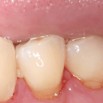 Soft Tissue Graft After