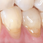 Soft Tissue Graft Before